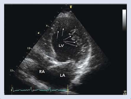 lv trabeculation involving apex and inferolateral wall and false cord|left ventricular trabeculation triad.